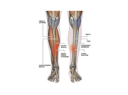 medial tibial stress syndrome prevention