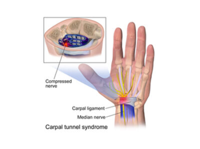 CARPAL TUNNEL SYNDROME – Rehab Max Physiotherapy Foot Ankle And Sports ...